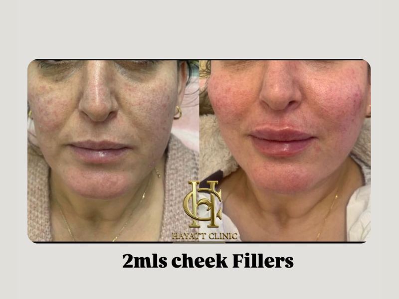 2mls cheek filler